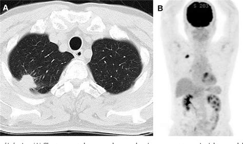 Figure 1 From Pulmonary Nocardiosis With A Tumor Like Solitary Nodule