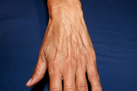 How To Treat Enlarged Hand Veins