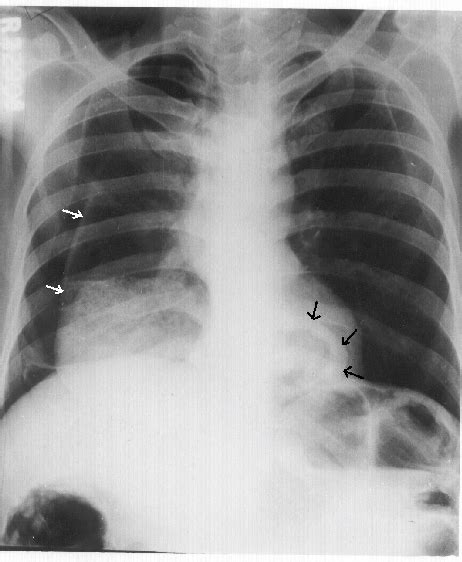 Fig Chest X Ray Showing Right Sided Pneumothorax White Arrows With