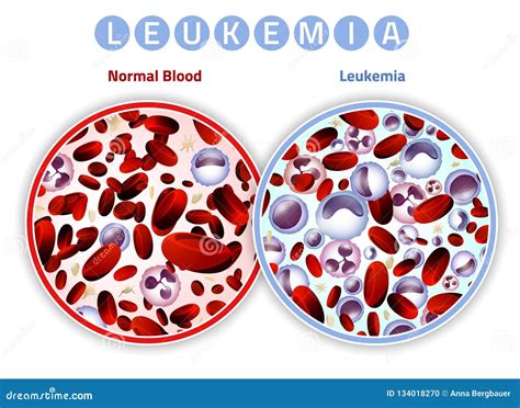 Leukemia Cartoons Illustrations And Vector Stock Images 4225 Pictures