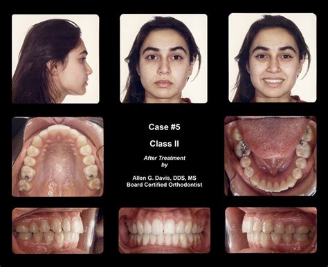 Before And After San Diego And Escondido Ca Davis Orthodontics