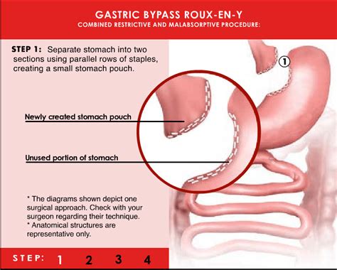 Gastric Bypass New Jersey Advanced Surgical Solutions
