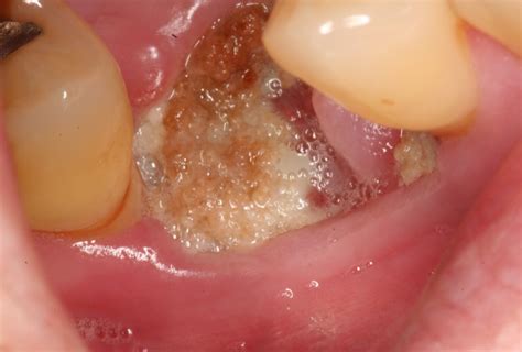 Complications Of Dental Extractions Geeky Medics