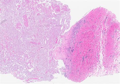 Pathology Outlines Microcysts