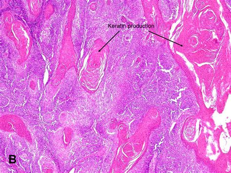 American Urological Association Squamous Cell Carcinoma