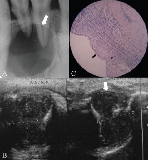 A C Periapical Cyst Intraoral Periapical Radiograph Open I
