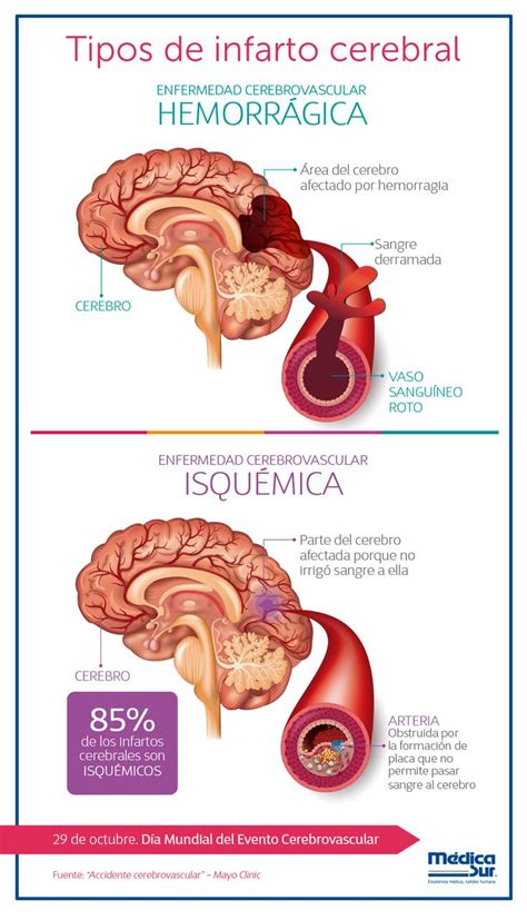 Accidente Cerebrovascular S Ntomas Y Causas