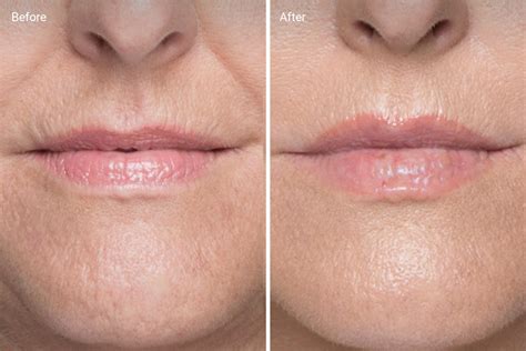 Lip Fillers How Long They Last Before And Afters Side Effects Cost
