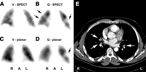 Tomographic Imaging In The Diagnosis Of Pulmonary Embolism A