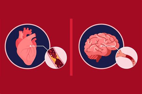 Stroke Vs Heart Attack Know The Signs And Symptoms Healthywomen