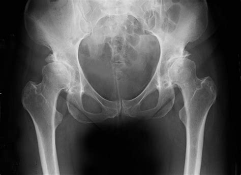 Hip Dysplasia And Double Hip Replacement Case Study Mr Nirav Shah