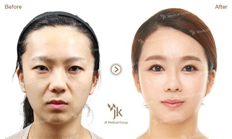 South Korea Plastic Surgery Eye Health Pictures Of Surgery Pictures