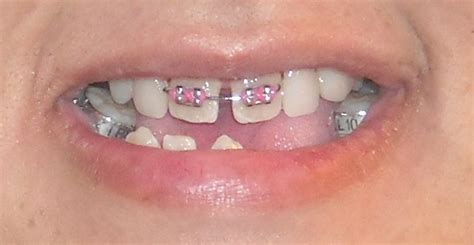 Is It Possible To Get Braces Only On 2 Front Teeth Vinmec