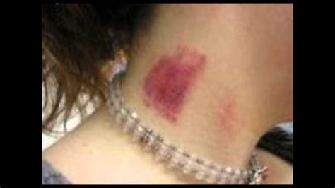 A hickey is a dark red or purple mark on your skin caused by intense suction. how to get rid of a hickey : how to get rid of a hickey ...