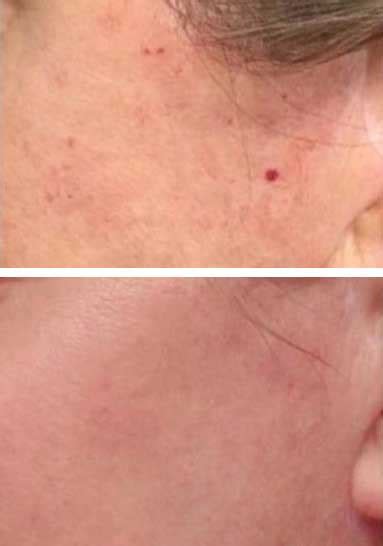 Cherry Angioma Removal Carlisle Instant Results Vl Aesthetics