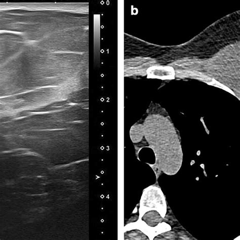 Sclerosing Adenosis Magnetic Resonance Imaging Of The Left Breast A