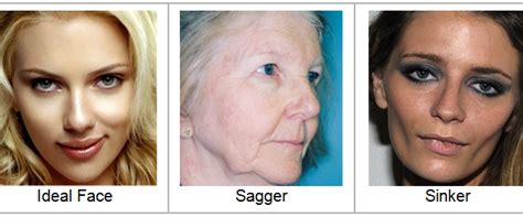 Fortunately, you can solve this problem quite easily with the right skin treatments. Sinker Sagger Wrinkler: Help for sagging cheeks, jowls. Austin best injector