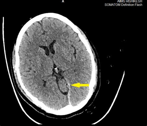 Cureus Extradural Anesthesia In A Case Of Mild Head Injury