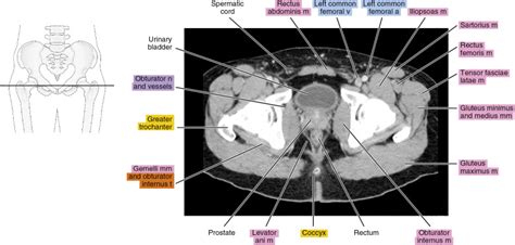 Learn Ct Scan Anatomy Ct Axial Abdomen And Pelvis Male Images