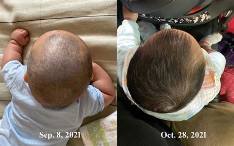 Ireal Helps Correct Babys Flat Head Syndrome Ireal 3d