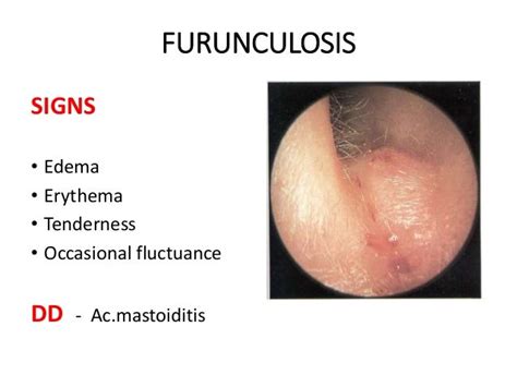 Diseases Of External Ear 1