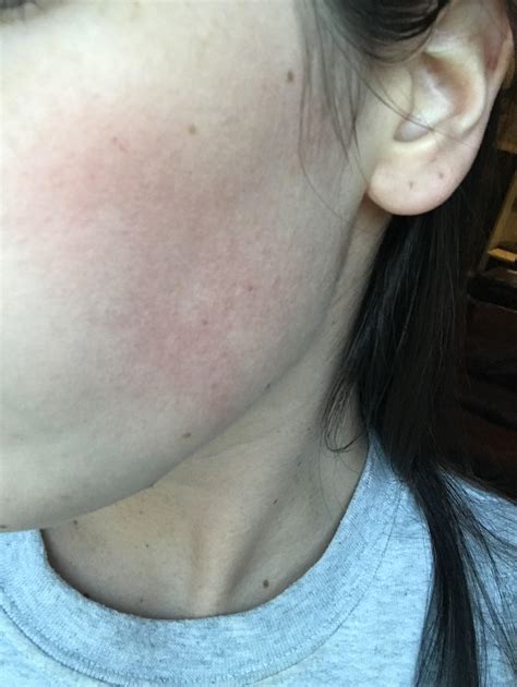 Skin Concern I Dont Think This Is Rosacea But Does Anyone Have Any