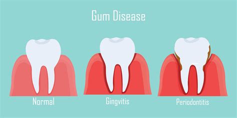 What Are The Symptoms Of Gingivitis