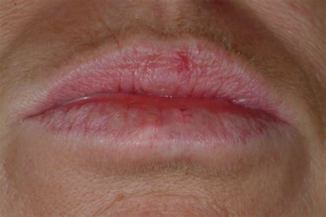 Basal Cell Carcinoma Lip