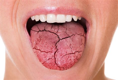 Dry Mouth And How To Treat It In 2021