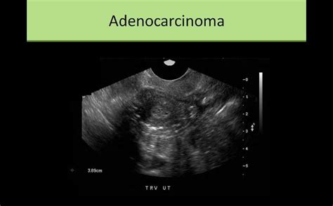 Adenocarcinoma Ultrasound Medical Mnemonics Sonography