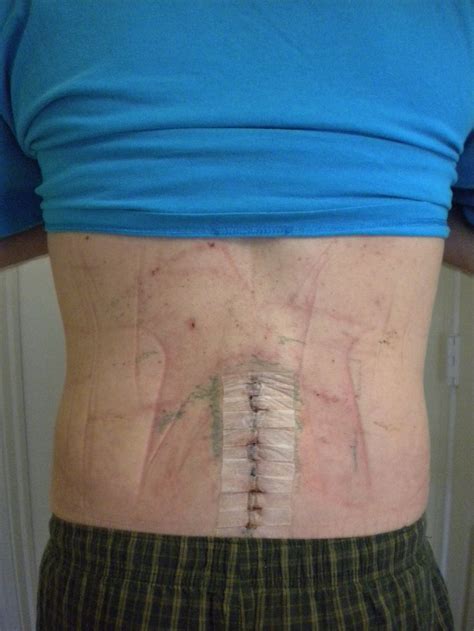 Photo Of Spinal Fusion Incision L4 And L5 Spinal Fusion
