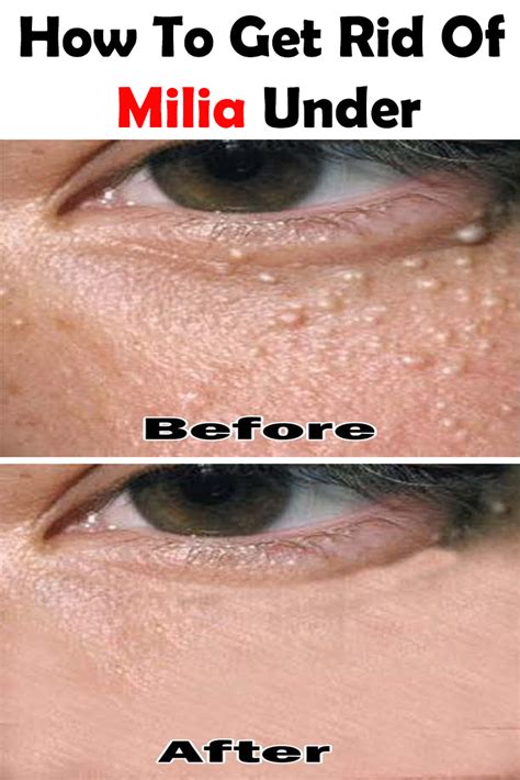 How To Get Rid Of Milia Under Eyes Natural Remedies For Milia Under
