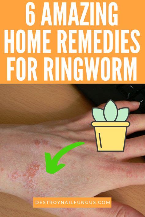 10 Best Ring Worm Ideas Home Remedies For Ringworm Ringworm Remedies