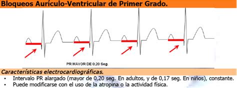 Ecg 81 Bloqueos Auriculoventriculares Cardio Science