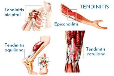 Diferencias Entre La Bursitis Y La Tendinitis Esvivir My Xxx Hot Girl