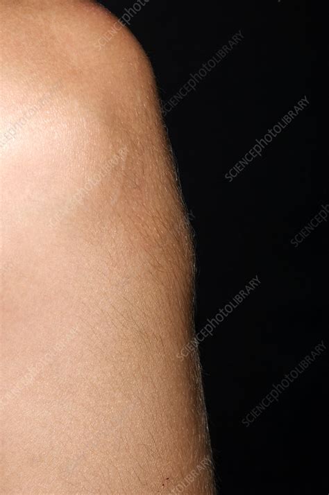 Osgood Schlatter Disease Stock Image M2300466 Science Photo Library