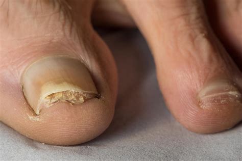 Fungal Nail Infection Nidirect