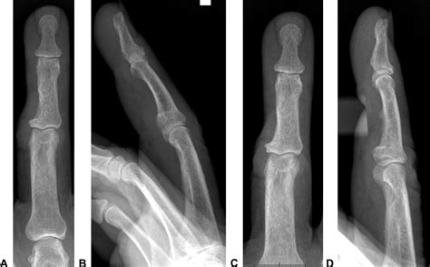 References In Disseminated Cryptococcal Osteomyelitis To The Hand In An