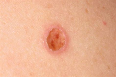 Surviving Skin Cancer Article The United States Army