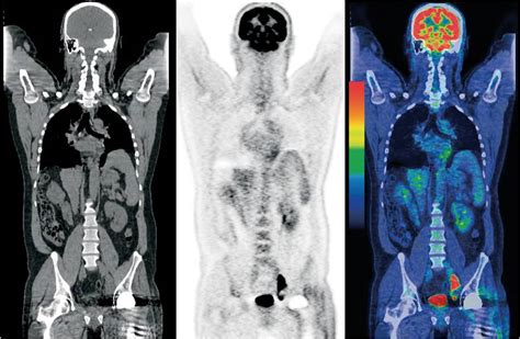 Pet Ct Guidelines Scottish Clinical Imaging Network