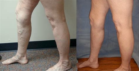 Varicose Vein Treatment Before And After The Results Are Awesome