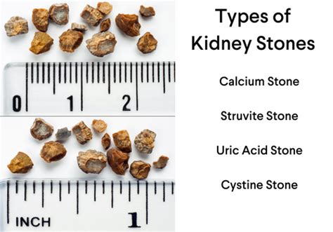 Kidney Stones Florida Urology Center
