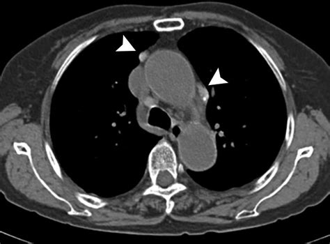 Delayed Isolation Of Active Pulmonary Tuberculosis In Hospitalized