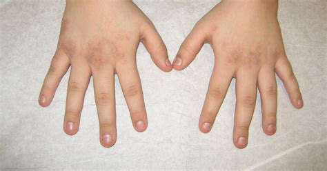 Virtual Grand Rounds In Dermatology Primary Care Hand Rash And Joint