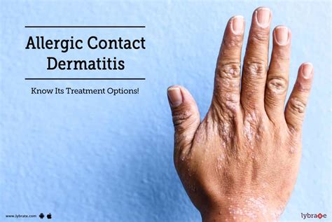 Allergic Contact Dermatitis Know Its Treatment Options By Dr Latika Arya Lybrate