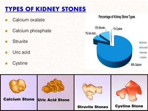Type Of Kidney Stone