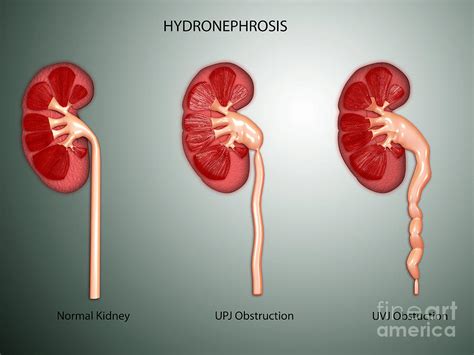 Hydronephrosis Condition Of The Kidney Digital Art By Stocktrek Images