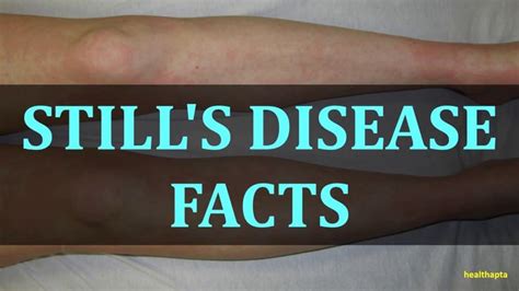 Stills Disease Facts
