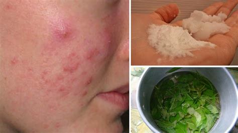 7 Cystic Acne Home Remedies That Really Work Youtube