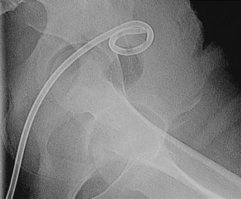 Percutaneous Imaging Guided Abdominal And Pelvic Abscess Drainage In